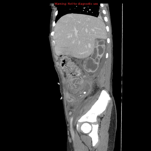 File:Appendicitis with phlegmon (Radiopaedia 9358-10046 F 11).jpg
