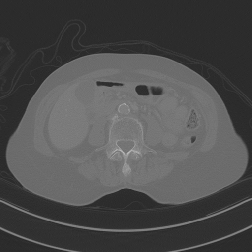 April fools' 2019- calcified peritoneal arachnoidosis (Radiopaedia 67273-76636 Axial bone window 22).png