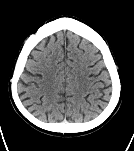 File:Aqueduct stenosis with corpus callosum hypoattenuation post shunting (Radiopaedia 37212-38971 Axial non-contrast 22).png
