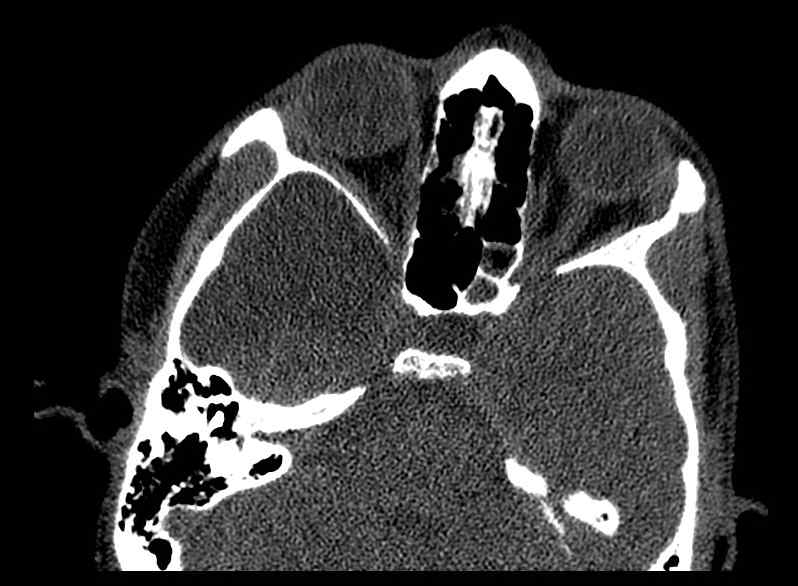 Arachnoid cyst- extremely large (Radiopaedia 68741-78450 Axial bone window 23).jpg