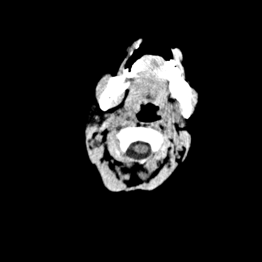 Arachnoid cyst-posterior fossa (Radiopaedia 88661-105370 Axial non-contrast 2).jpg