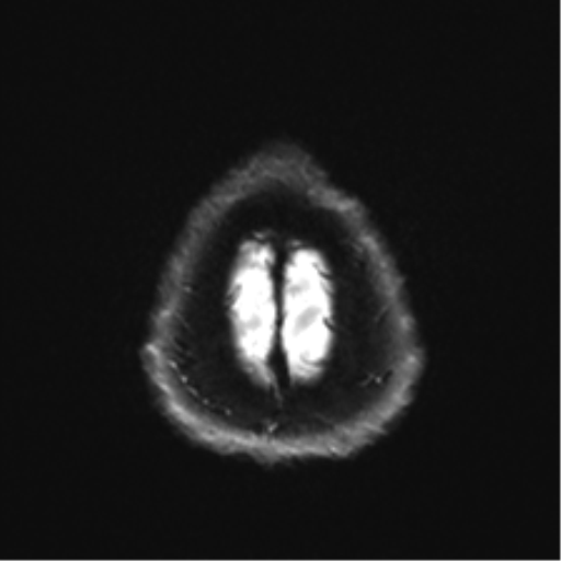 Arachnoid cyst - cerebellopontine angle (Radiopaedia 59689-67083 Axial DWI 35).png