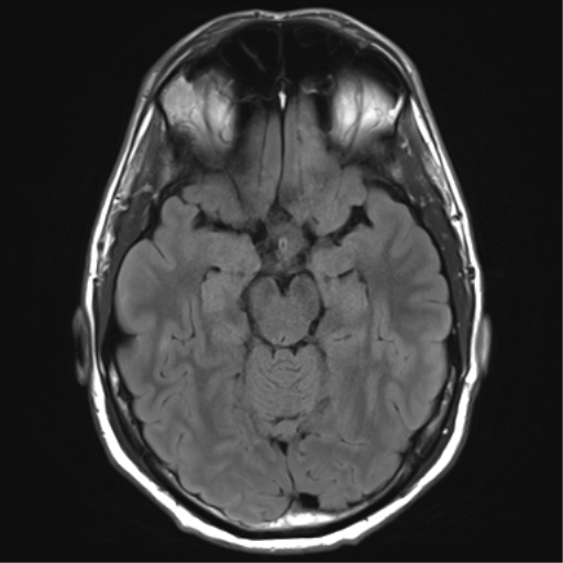 File:Arachnoid cyst - cerebellopontine angle (Radiopaedia 59689-67083 Axial FLAIR 15).png