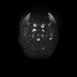Arachnoid cyst - middle cranial fossa (Radiopaedia 67671-77088 Axial DWI 1).jpg