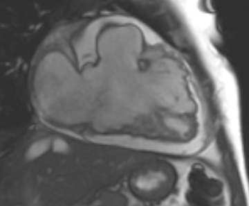 File:Arrhythmogenic right ventricular cardiomyopathy (Radiopaedia 69431-79307 2ch cine 67).jpg