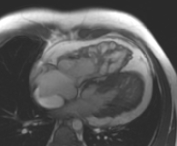 Arrhythmogenic right ventricular cardiomyopathy (Radiopaedia 69431-79307 4ch cine 10).jpg