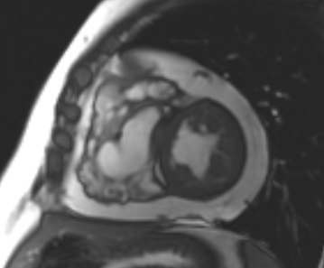Arrhythmogenic right ventricular cardiomyopathy (Radiopaedia 69431-79307 Short axis cine 108).jpg