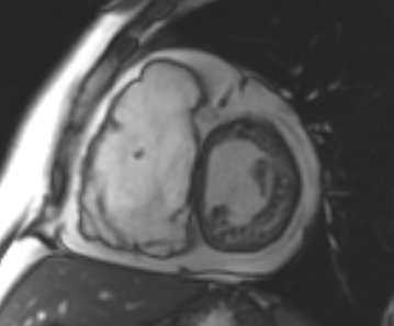 Arrhythmogenic right ventricular cardiomyopathy (Radiopaedia 69431-79307 Short axis cine 158).jpg