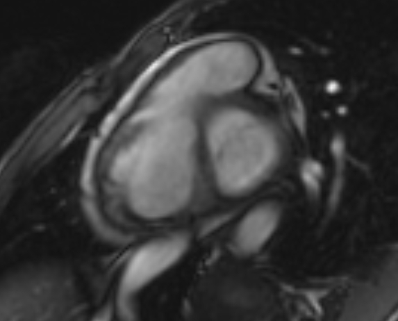 Arrhythmogenic right ventricular cardiomyopathy (Radiopaedia 69564-79464 short axis cine 229).jpg
