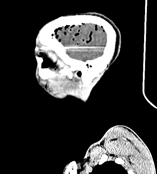 Arrow injury to the brain (Radiopaedia 72101-82607 H 52).jpg