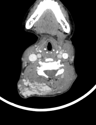 File:Arteriovenous malformation of the neck (Radiopaedia 53935-60062 B 26).jpg