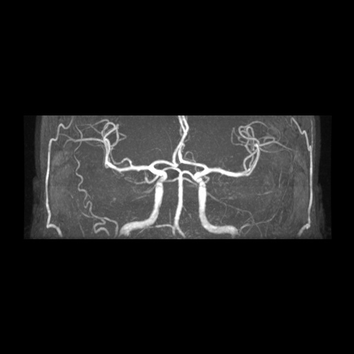 Artery of Percheron infarction (Radiopaedia 27975-28230 3D TOF 11).jpg
