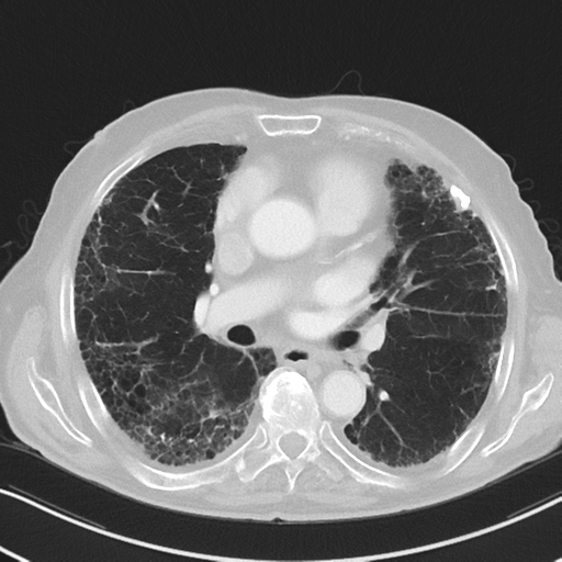 File:Asbestosis (Radiopaedia 56192-62864 Axial lung window 33).png