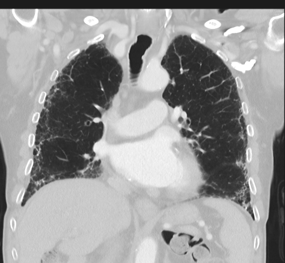 Asbestosis (Radiopaedia 56192-62864 Coronal lung window 25).png
