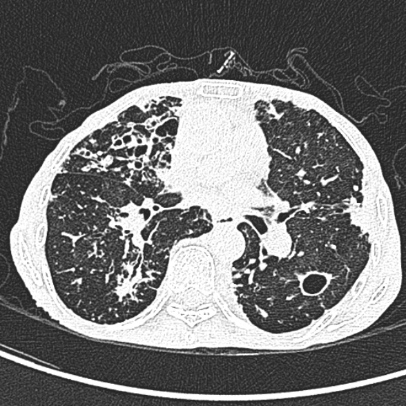 File:Aspergilloma- with Monod sign (Radiopaedia 44737-48532 Axial lung window 136).jpg