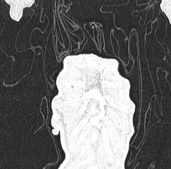Aspergilloma- with Monod sign (Radiopaedia 44737-48532 Coronal lung window 112).jpg