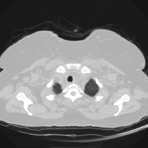 Aspergilloma (Radiopaedia 39611-41932 Axial lung window 4).jpg