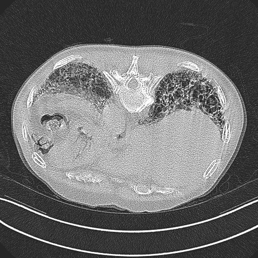 File:Aspergilloma on background pulmonary fibrosis (Radiopaedia 60942-68757 Axial lung window 26).jpg