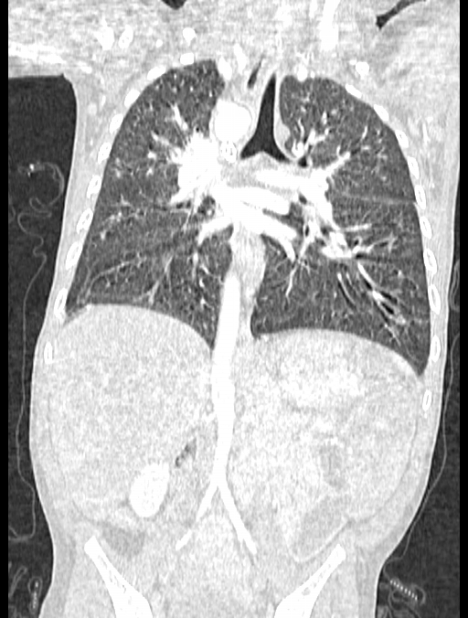 Asplenia syndrome (Radiopaedia 73083-83792 Coronal lung window 83).jpg