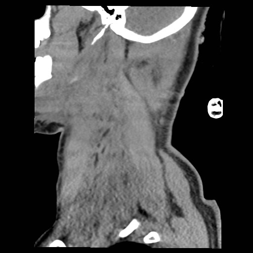 File:Atlanto-occipital dislocation (Radiopaedia 44648-48412 A 28).jpg