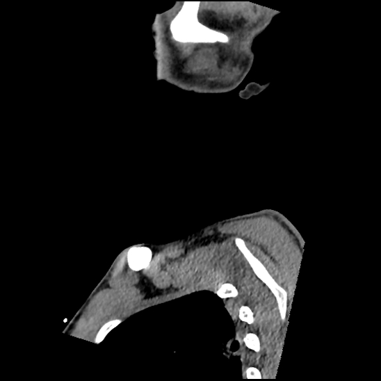 Atlanto-occipital dissociation (Traynelis type 1), C2 teardrop fracture, C6-7 facet joint dislocation (Radiopaedia 87655-104061 D 6).jpg