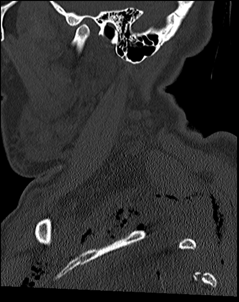 Atlanto-occipital dissociation - Traynelis type 1 (Radiopaedia 87570-103948 Sagittal bone window 19).jpg