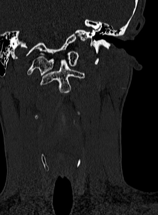 Atlantoaxial subluxation (Radiopaedia 44681-48450 Coronal bone window 11).jpg