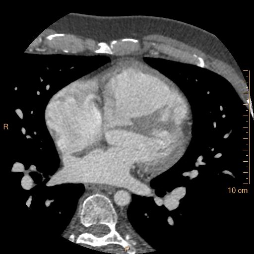Atrial septal defect (upper sinus venosus type) with partial anomalous pulmonary venous return into superior vena cava (Radiopaedia 73228-83961 A 131).jpg