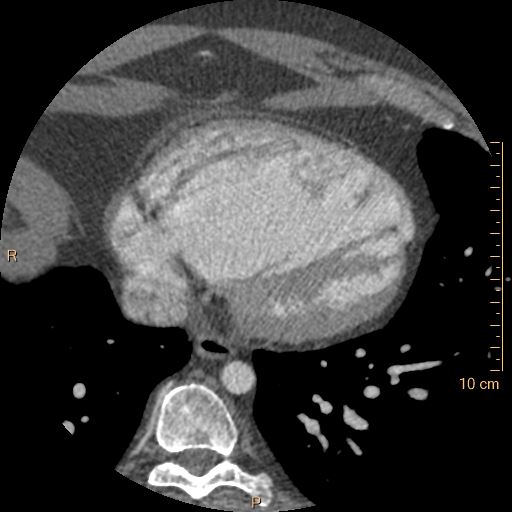 Atrial septal defect (upper sinus venosus type) with partial anomalous pulmonary venous return into superior vena cava (Radiopaedia 73228-83961 A 212).jpg