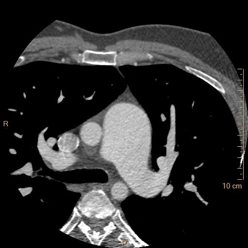 Atrial septal defect (upper sinus venosus type) with partial anomalous pulmonary venous return into superior vena cava (Radiopaedia 73228-83961 A 40).jpg