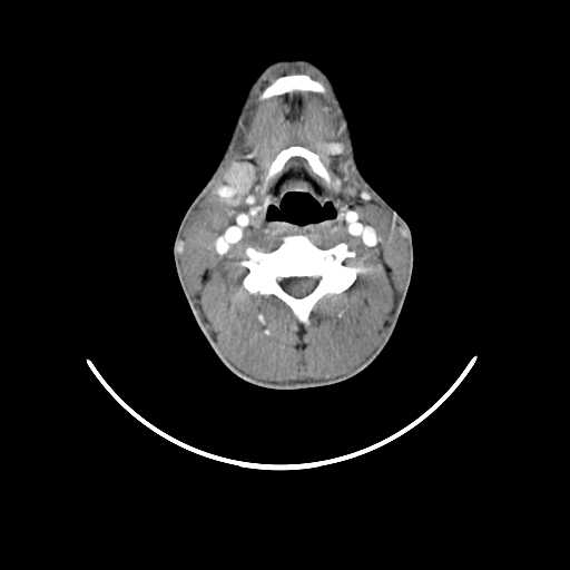 File:Atypical 2nd branchial cleft cyst (type IV) - infected (Radiopaedia 20986-20924 A 16).jpg