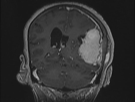 Atypical meningioma (Radiopaedia 62985-71406 Coronal T1 C+ 81).jpg