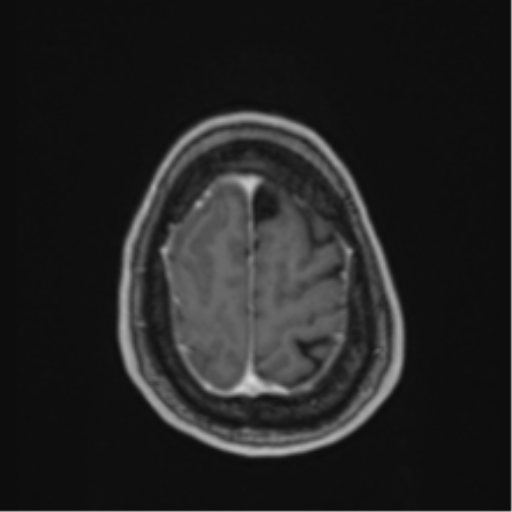 Atypical meningioma (WHO Grade II) (Radiopaedia 54742-60979 Axial T1 C+ 59).png