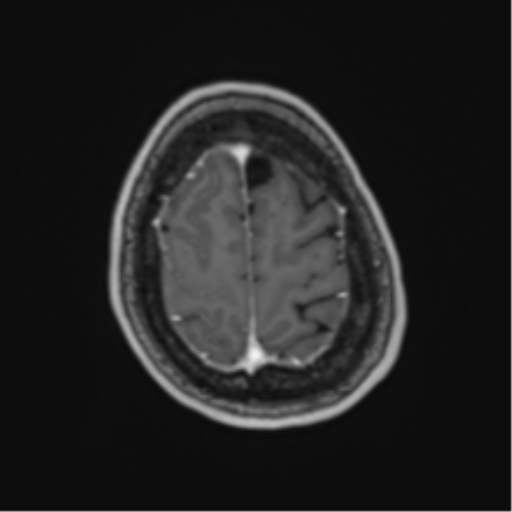 File:Atypical meningioma (WHO Grade II) (Radiopaedia 54742-60981 Axial T1 C+ 61).png