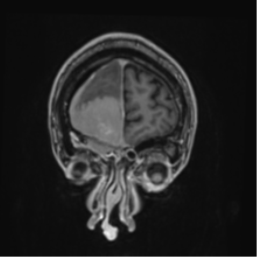 Atypical meningioma (WHO grade II) with brain invasion (Radiopaedia 57767-64729 Coronal T1 C+ 6).png