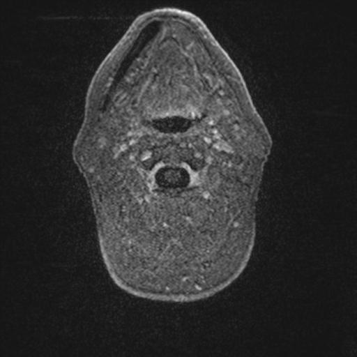 Atypical meningioma (grade II) - en plaque (Radiopaedia 29633-30147 Axial T1 C+ 3).jpg