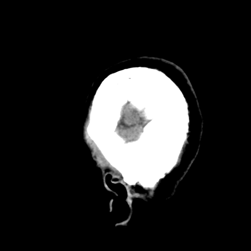 Atypical meningioma with skull invasion (Radiopaedia 34357-35649 E 51).png