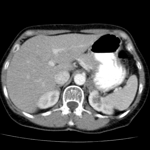 File:Atypical renal cyst (Radiopaedia 17536-17251 renal cortical phase 6).jpg