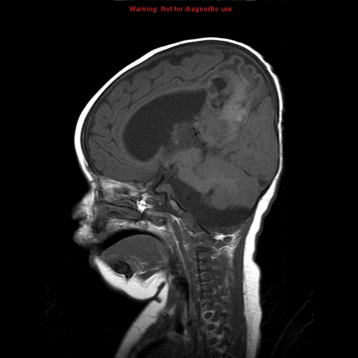 File:Atypical teratoid rhabdoid tumor (Radiopaedia 10712-11183 Sagittal T1 12).jpg