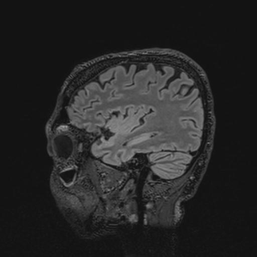 Autoimmune limbic encephalitis (Radiopaedia 30363-31005 Sagittal FLAIR 45).jpg