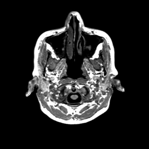 Autoimmune limbic encephalitis (Radiopaedia 30363-31005 T1 Axial 1mm 11).jpg