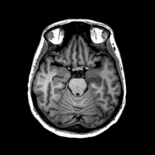 File:Autoimmune limbic encephalitis (Radiopaedia 30363-31005 T1 Axial 1mm 58).jpg