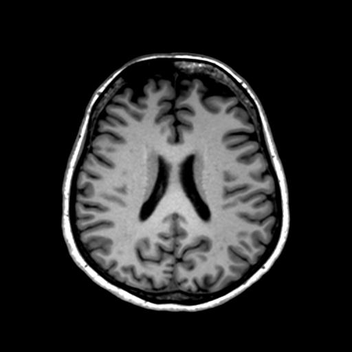 File:Autoimmune limbic encephalitis (Radiopaedia 30363-31005 T1 Axial 1mm 95).jpg