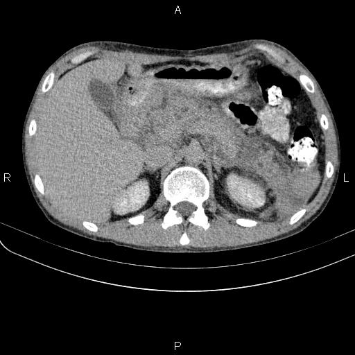 Autoimmune pancreatitis (Radiopaedia 84925-100431 Axial C+ delayed 20).jpg
