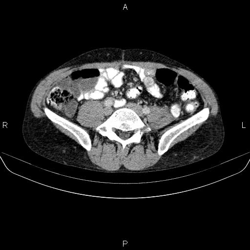 File:Autoimmune pancreatitis (Radiopaedia 84925-100431 B 37).jpg