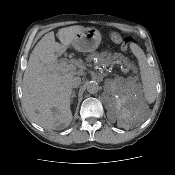 Autosomal dominant polycystic kidney disease (Radiopaedia 27851-28094 Axial non-contrast 58).jpg