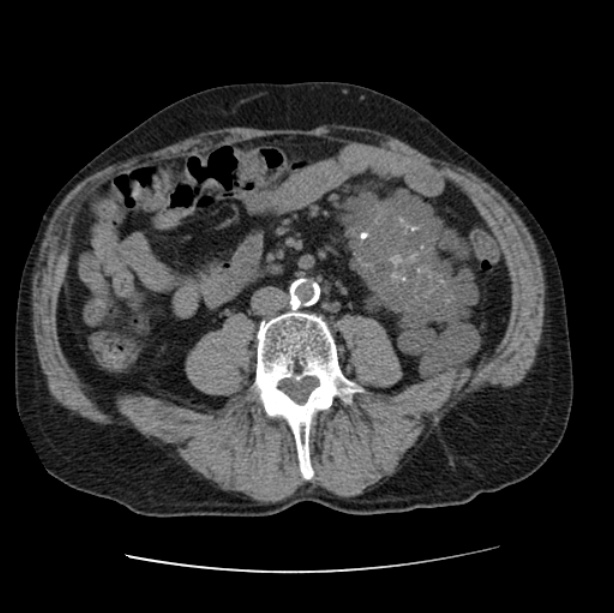 Autosomal dominant polycystic kidney disease (Radiopaedia 27851-28094 Axial non-contrast 81).jpg
