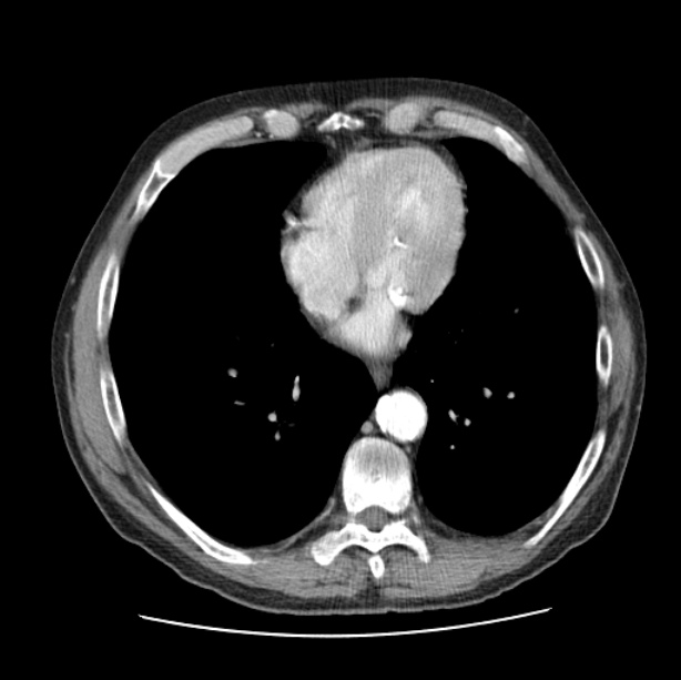 Autosomal dominant polycystic kidney disease (Radiopaedia 27851-28094 B 41).jpg