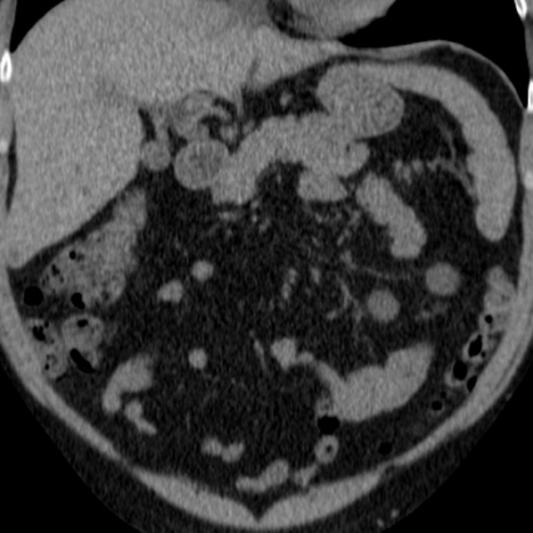File:Autosomal dominant polycystic kidney disease (Radiopaedia 36539-38101 Coronal non-contrast 6).jpg