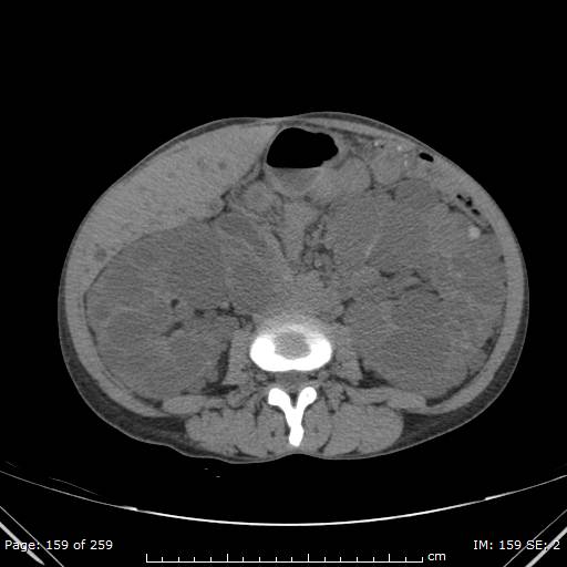 File:Autosomal dominant polycystic kidney disease (Radiopaedia 44122-47684 Axial 20).jpg